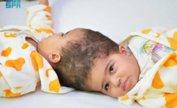 بمشاركة 36 متخصصًا.. نجاح فصل التوأم الإريتري «أسماء وسمية»  في السعودية بعد جراحة دقيقة استغرقت 15 ساعة ونصفًا