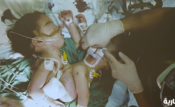 بالفيديو: مشاهد من داخل عملية التوأم السيامي السوري «سيلين وإيلين»