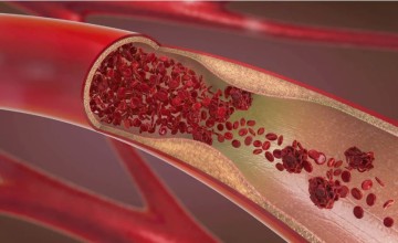 “خطر في آخر أيام رمضان”.. استشاري أوعية دموية يحذر من سبب مفاجئ لجلطات الشرايين (شاهد)