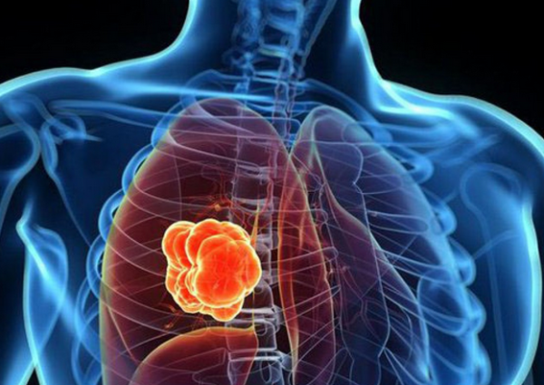 مشروب بـ”ريال” في البقالات يقي من خطر الإصابة بـ”سرطان الرئة”