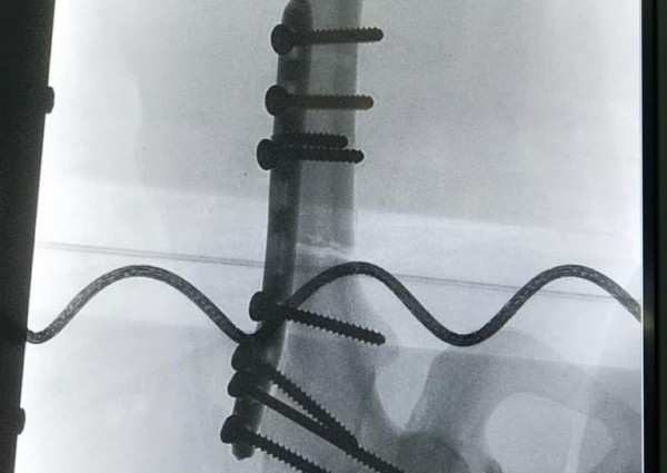 جراحة معقدة لحالتي العظم الرخامي في مستشفى الدوادمي العام