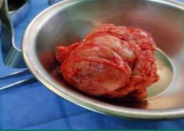 مستشفى صوير العام ينهي معاناة سيدة من ورم ليفي وزنه ٥٠٠ جم