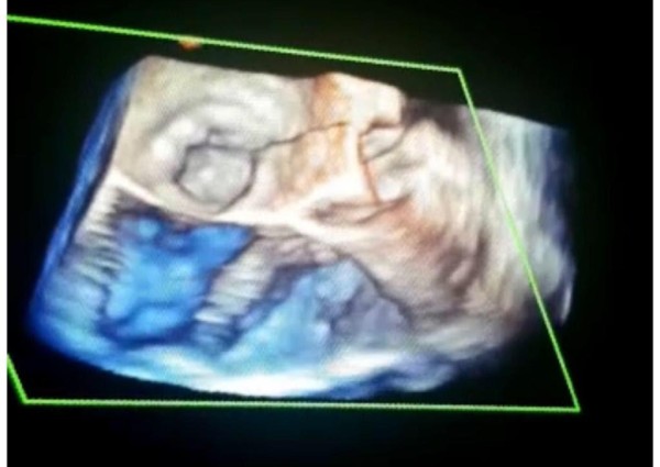 مركز القلب بالجوف ينجح في استخدام منظار القلب