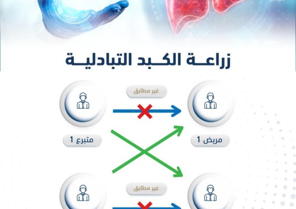 في عملية تعد الأولى من نوعها في الشرق الأوسط نجاح أول زراعة كبد تبادلية في تخصصي الدمام