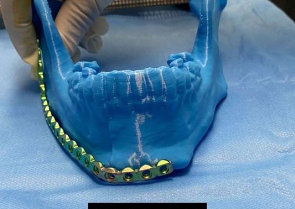 “تخصصي تبوك” يتمكن من إعادة بناء فك مريض