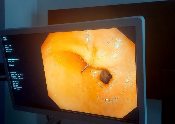 فريق طبي بمستشفى الملك فهد التخصصي ببريدة ينجح في استخراج إبرة خياطة من معدة مريضة