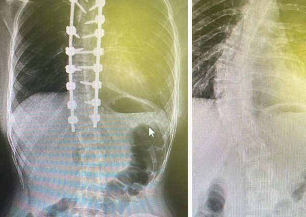 إنهاء معاناة فتاة بعملية جراحية نوعية في مجمع الملك عبدالله الطبي بجدة