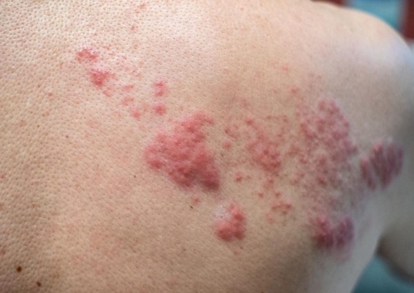 للعام الرابع على التوالي.. إقامة أسبوع التوعية بمرض الحزام الناري بالمملكة