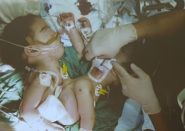 بالفيديو: مشاهد من داخل عملية التوأم السيامي السوري «سيلين وإيلين»