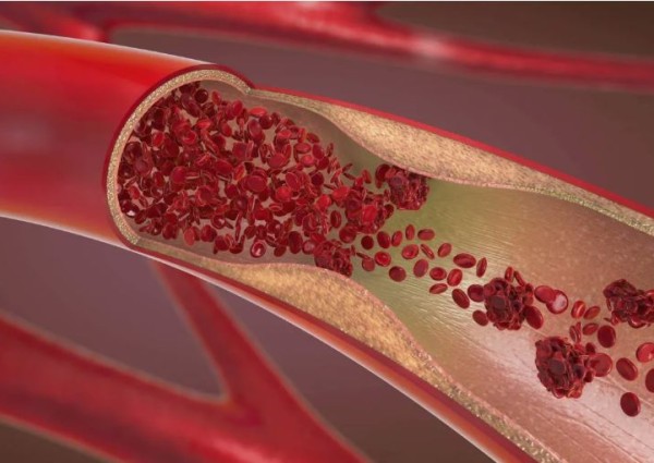 “خطر في آخر أيام رمضان”.. استشاري أوعية دموية يحذر من سبب مفاجئ لجلطات الشرايين (شاهد)