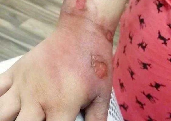 والد “الطفلة المحترقة بالقهوة” يعفو عن المتسببين في الواقعة قبل صدور نتائج التحقيق