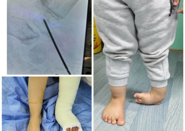 إنهاء معاناة طفل من تشوه بالقدم
