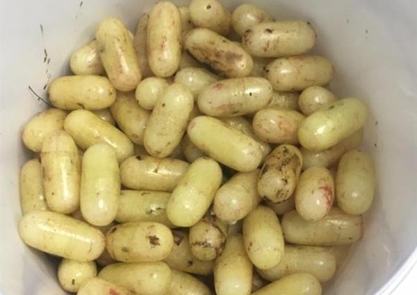 معتمر يحاول تهريب 120 كبسولة حبوب في أحشائه.. وفريق طبي ينقذ حياته بمكة