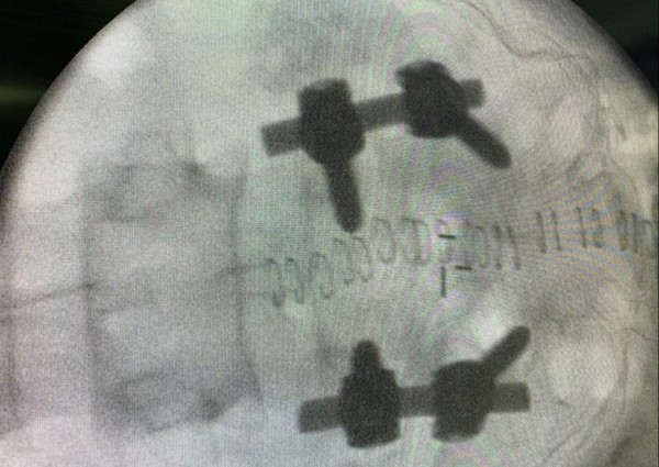 مركزي حفرالباطن يثبت الفقرات “لأربعيني” يعاني من انزلاق عجزي من الدرجة الثانية