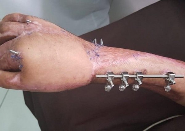 جدة.. إنقاذ يد شاب من البتر بمستشفى الملك عبدالعزيز