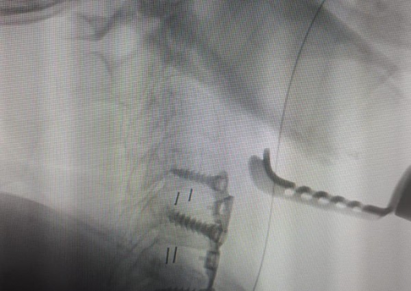 تدخل جراحي ناجح ينهي معاناة سيدة من الانزلاق الغظروفي بحفرالباطن