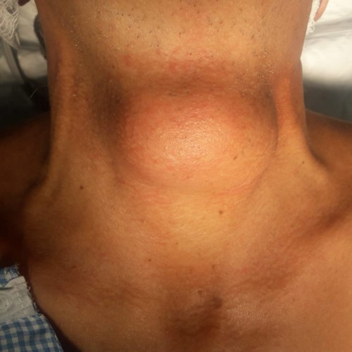 نجاح عملية إستئصال ورم في الرقبة