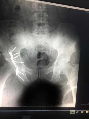 عملية جراحية معقدة وناجحة لكسر مفتت