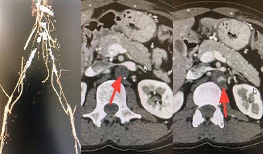 جراحة ناجحة لأربعيني بالخبر كاد أن يفقد الحركة
