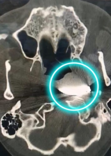 مقذوف مسماري يخترق وجه عامل خمسيني .. و”سعود الطبية” تنقذه