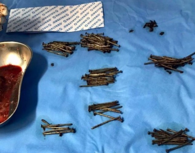 فريق طبي في مستشفى بـ”جدة” ينقذ مريض ويستخرج 230 مسمار وقطع زجاج من بطنه – صور