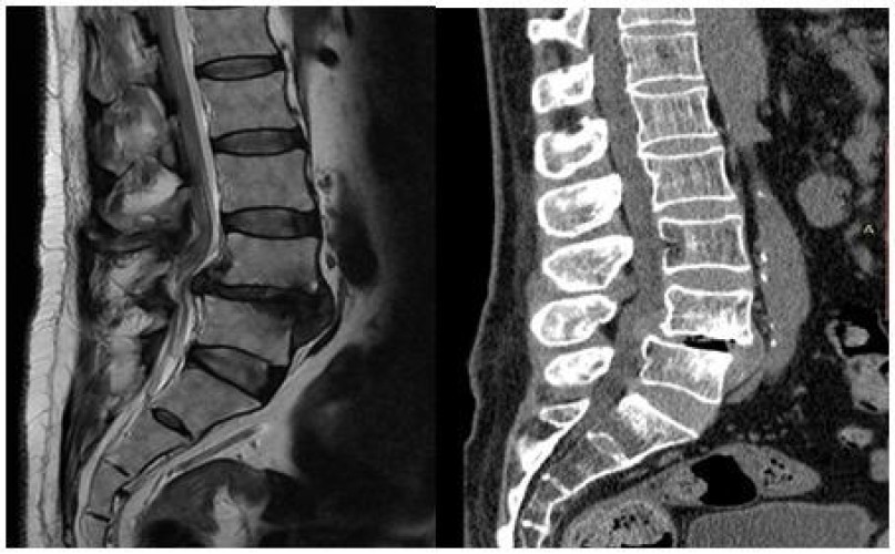 نجاح جراحة نادرة ونوعية لإعادة الحركة لمريض في مستشفى “وادي الدواسر”