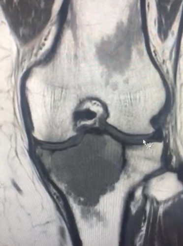 فريق طبي ينجح في استئصال ورم في عظمة ساق مريضة في مستشفى المدينة المنورة