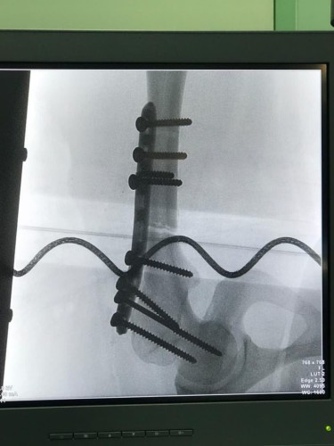 جراحة معقدة لحالتي العظم الرخامي في مستشفى الدوادمي العام