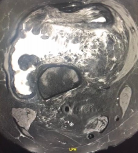 بدء العمل في جراحة أورام العظام والعضلات في مستشفى المدينة المنورة