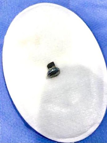 فريق طبي في مستشفى العيون بجدة يتمكن من  استخراج جزء مكسور من مسمار صلب داخل عين مريض