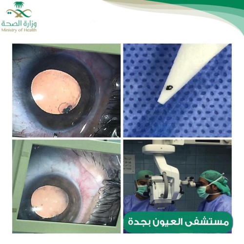 استشاريون بعيون جدة يستخرجون بقايا مسمار