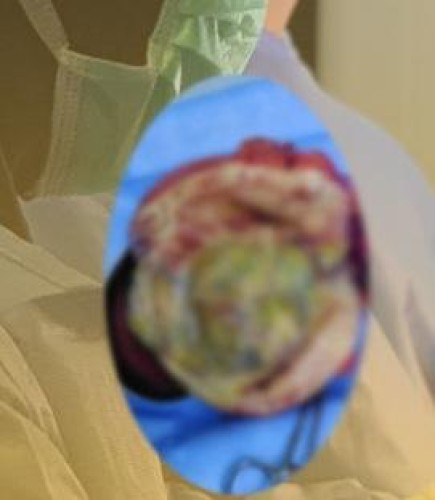 مستشفى دومة الجندل ينهي معاناة مريضة من ورم ليفي وزنه 3 كجم