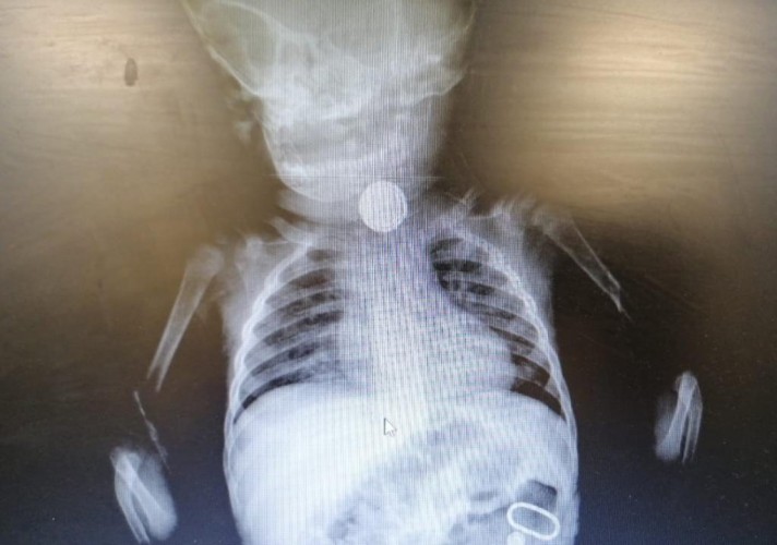 مستشفى القريات العام ينهي معاناة رضيع