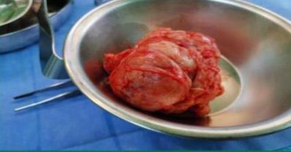 مستشفى صوير العام ينهي معاناة سيدة من ورم ليفي وزنه ٥٠٠ جم