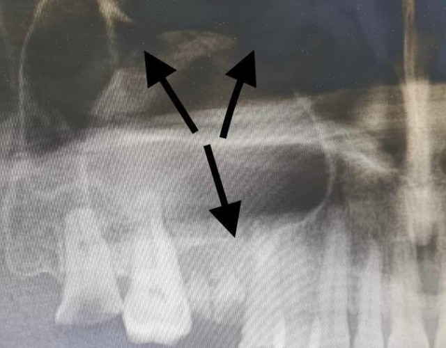 تدخل طبي ناجح في مستشفى القريات العام لإستئصال ورم من الفك العلوي لمريض