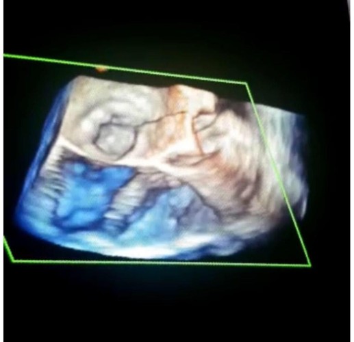 مركز القلب بالجوف ينجح في استخدام منظار القلب