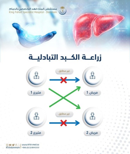 في عملية تعد الأولى من نوعها في الشرق الأوسط نجاح أول زراعة كبد تبادلية في تخصصي الدمام