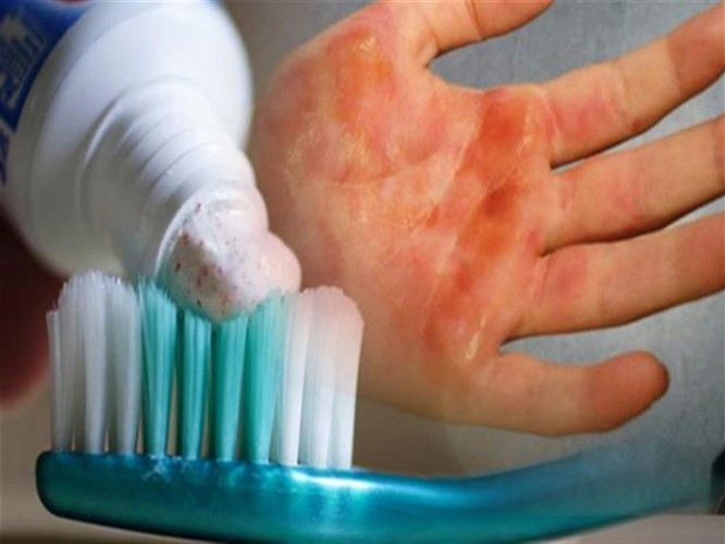“الصحة الخليجي”: علاج الحروق بمعجون الأسنان “شائعة”.. وهذه طريقة العلاج الصحيحة