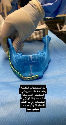 “تخصصي تبوك” يتمكن من إعادة بناء فك مريض