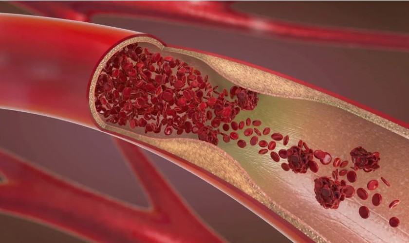 “خطر في آخر أيام رمضان”.. استشاري أوعية دموية يحذر من سبب مفاجئ لجلطات الشرايين (شاهد)
