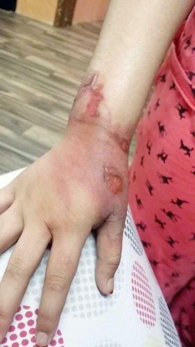 والد “الطفلة المحترقة بالقهوة” يعفو عن المتسببين في الواقعة قبل صدور نتائج التحقيق