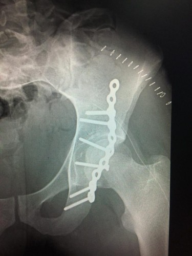 نجاح عملية جراحية لكسر بالجوف المفصلي بالقريات