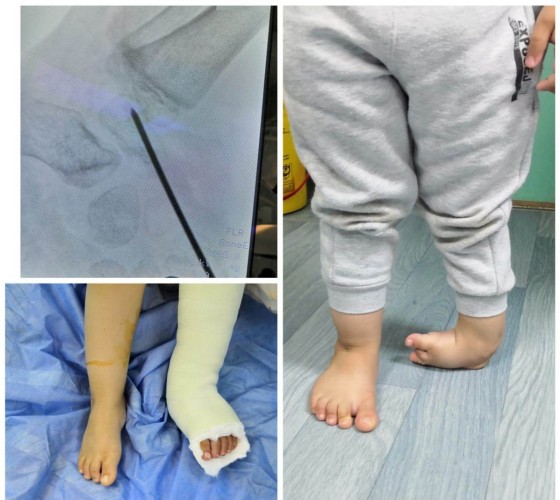 إنهاء معاناة طفل من تشوه بالقدم