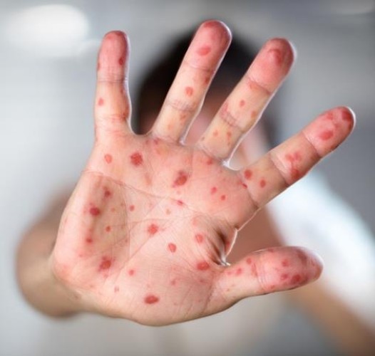 وزارة الصحة تعلن انطلاق الحملة الوطنية للتطعيم ضد الحصبة