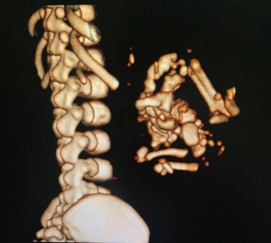 حالة نادرة.. ولادة حية لـ”جنين داخل جنين” بمستشفى “الهدا العسكري” بالطائف