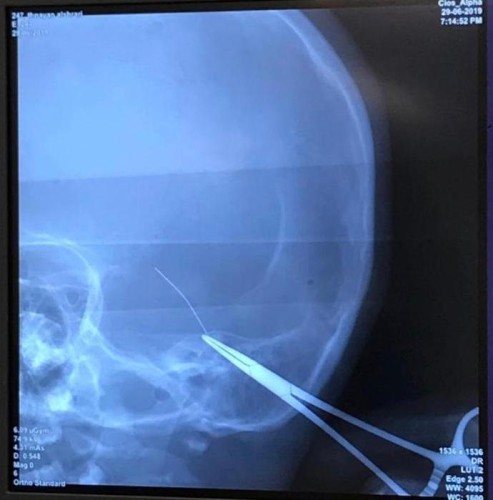 استخراج “إبرة خياطة” من رأس طفل بمستشفى القريات