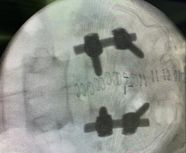 مركزي حفرالباطن يثبت الفقرات “لأربعيني” يعاني من انزلاق عجزي من الدرجة الثانية