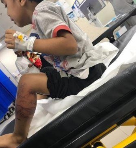 والد الطفل الملسوع يفند ادعاءات “صحة جازان” بأنه أخرج ابنه من المستشفى قبل اكتمال علاجه