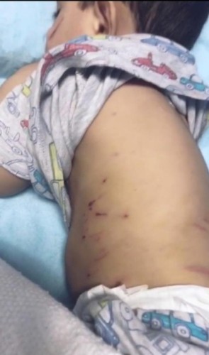 هجوم شرس لكلاب ضالة على طفل بالأحساء .. والأمانة تعلن عن تحرك عاجل