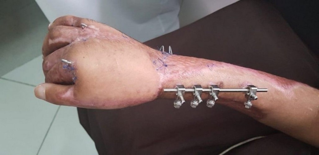 جدة.. إنقاذ يد شاب من البتر بمستشفى الملك عبدالعزيز